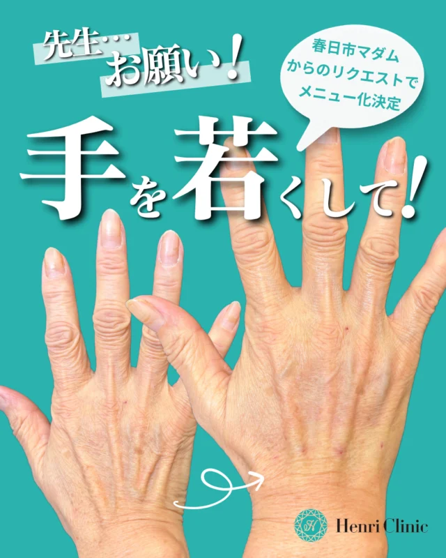 メイクや医療でお顔は若々しいけど…⁠
＼＼👐"手だけオバハン"増えてます💦／／⁠
⁠
意外と見られてる！？👀⁠
「手年齢」の若返りを目指しませんか🍀⁠
⁠
年を重ねるごとに手の甲のボリュームがなくなり、⁠
骨が浮き出て、ハリがなくなりシワが増加。。。💦⁠
⁠
マダム向け美容医療も得意とする⁠
勝川アンリ・野々垣Drが⁠
患者さまのリクエストにお応えして✨⁠
「手背ヒアル」MENUをスタートしました👏⁠
⁠
ヒアルロン酸×レーザー治療で⁠
若々しい自然な丸みがある手を取り戻しましょう！⁠
⁠
✅ボリュームロスにヒアルロン酸⁠
✅シミにはピコスポット（シミ取り）⁠
✅くすみにはピコトーニング⁠
全て掛け合わせて最強のエイジングケアを✨⁠
⁠
野々垣DR自らも効果を実証済み🥼💉⁠
⁠
皆様のお問い合わせ💌ご予約をお待ちしております！⁠
是非お試しくださいませ🤭⁠
⁠
⁠
#アンリクリニック #アンリクリニック勝川院 #HenriClinic⁠
#美容皮膚科 #美容クリニック #春日井美容皮膚科 #勝川美容クリニック⁠
#エイジングケア #若返り #手の甲 #手背 #ヒアルロン酸 #シミ取り⁠
#ハンドケア #50代美容 #60代美容 #70代美容